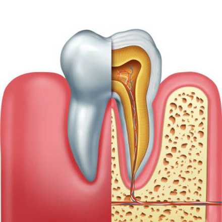Root Canal